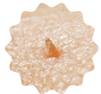 蓄積された角質